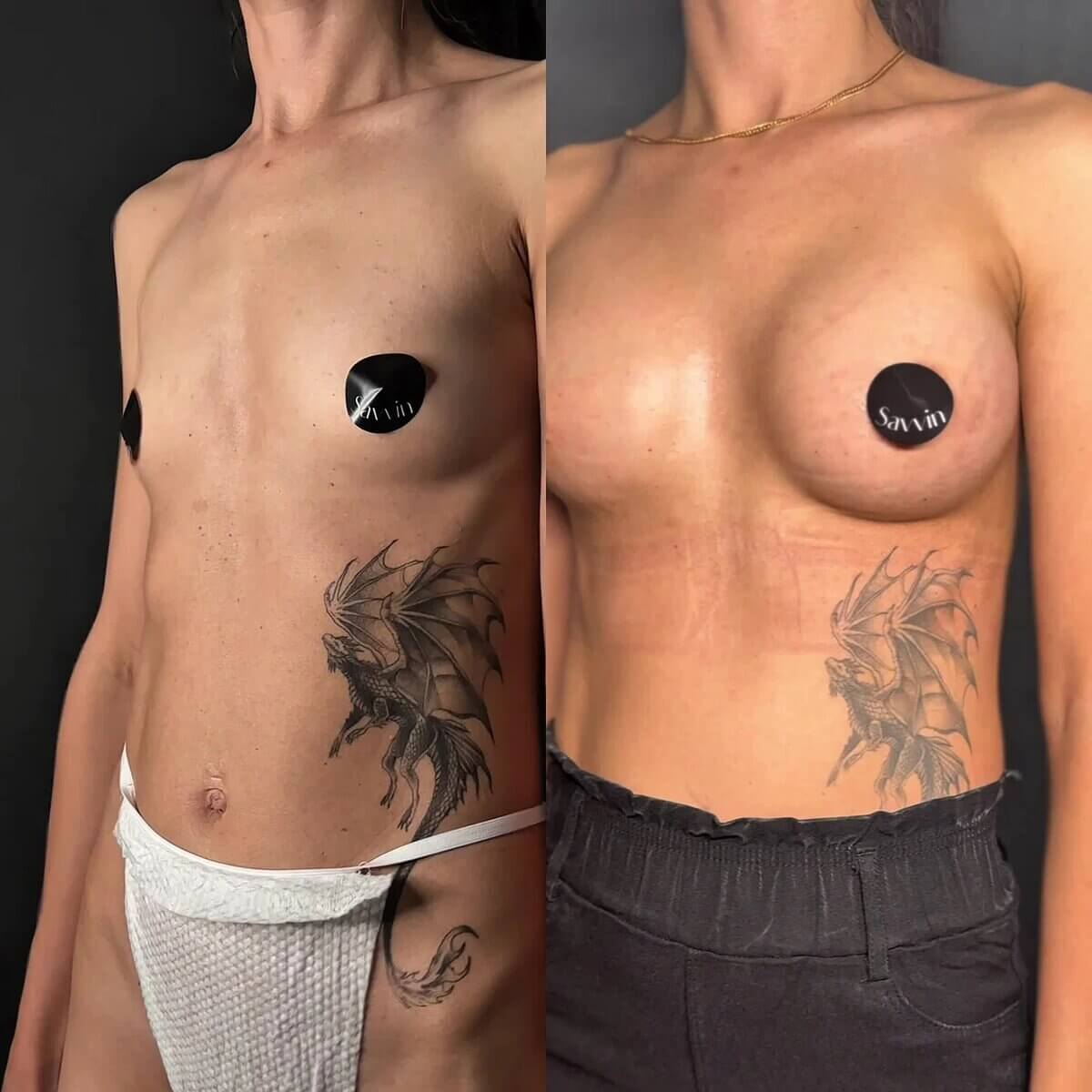 Всего месяц после увеличения груди. 