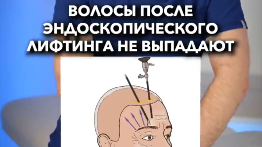 Выпадают волосы после эндоскопического лифтинга? 