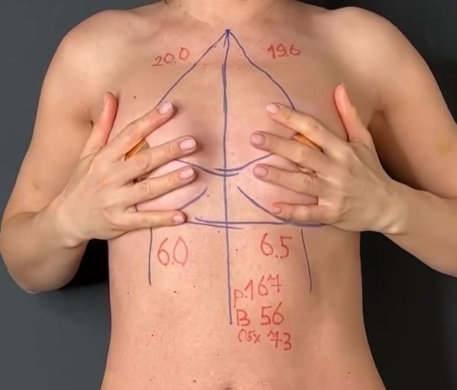 Сегодня будем выполнять увеличение груди по методике «Грудь без Шва».