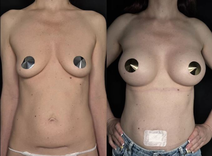 Не всем нужна большая грудь.  Иногда нужна своя.