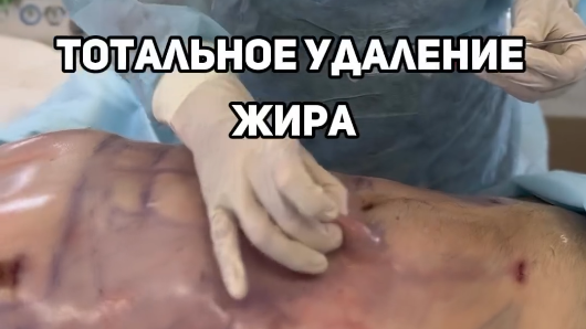 Бодибилдинг липопластика у мужчины