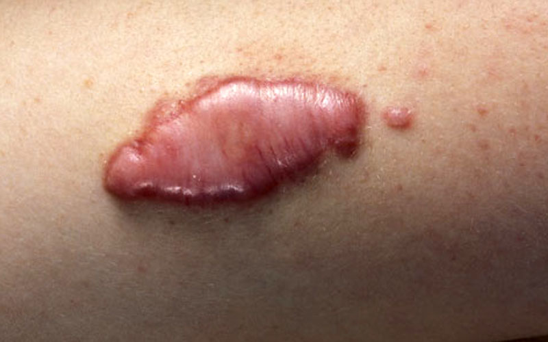 Лечение рубцов и шрамов