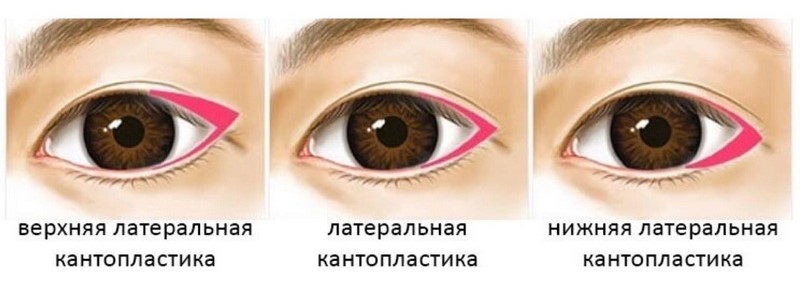 Поднятие наружных уголков глаз