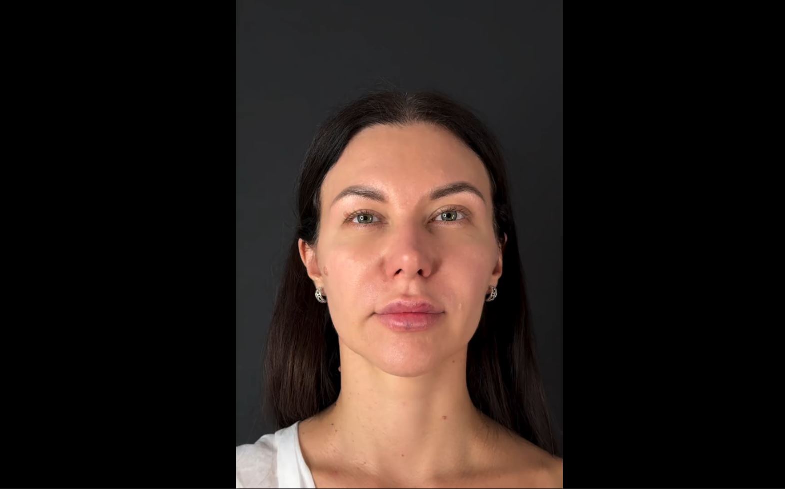 Очень много пациентов хотят, чтобы пластика лица была не заметна. 