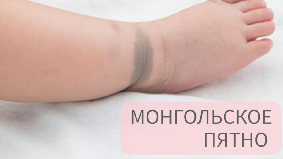 Что такое монгольское пятно?