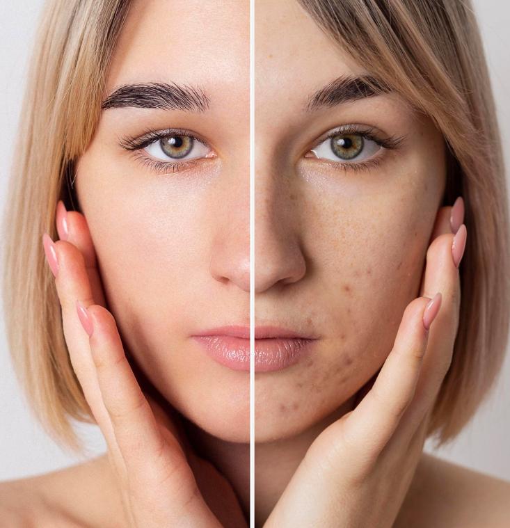 Фототерапия акне