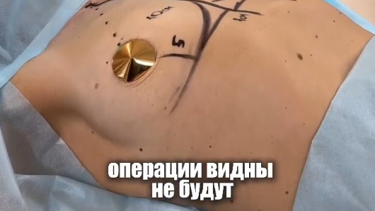Грудь без шва - эти эстетичная красивая грудь без следов от операции! Для записи на консультацию пишите в директ!
