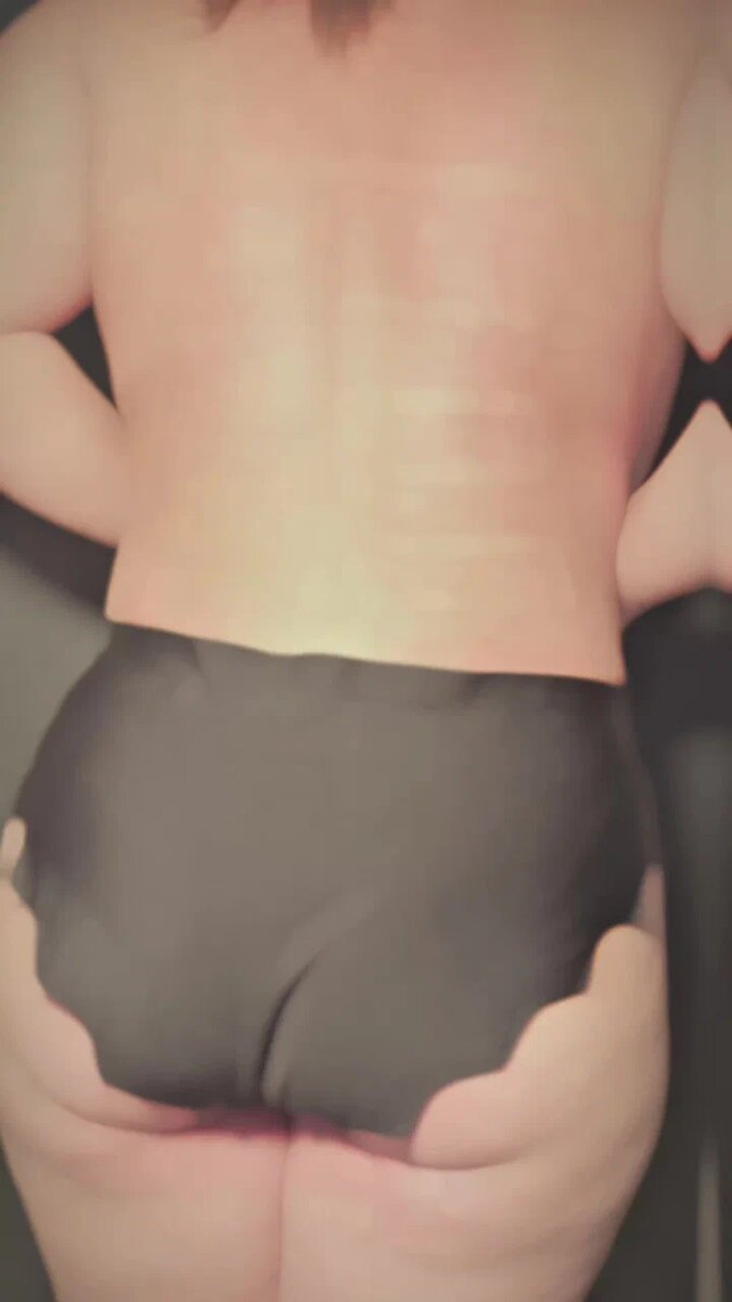 Плоский живот через 1,5 месяца после абдоминопластики.