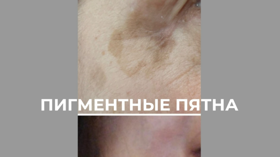 Результат после одной процедуры удаления пигментного пятна...