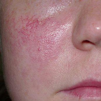 Удаление расширенных сосудов