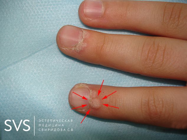 Удаление бородавки