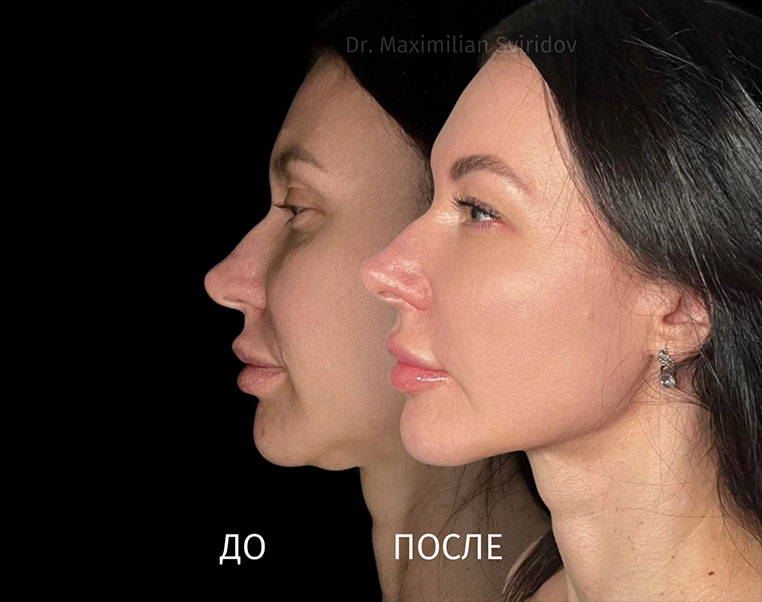 Четкий контур лица за 35 минут: революционная операция