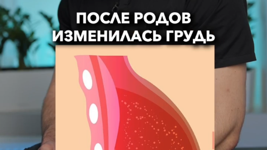 Т-образная подтяжка после родов