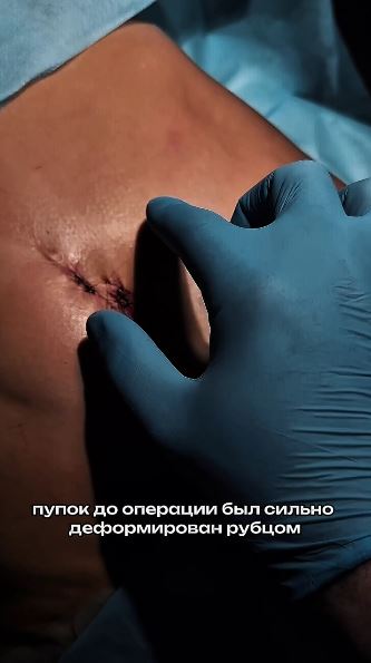 К сожалению, убрать все неровности за 1 операцию нельзя. 