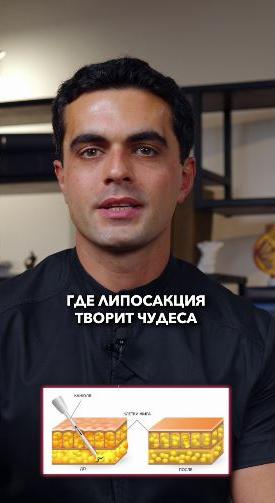 Три зоны где липосакция творит чудеса