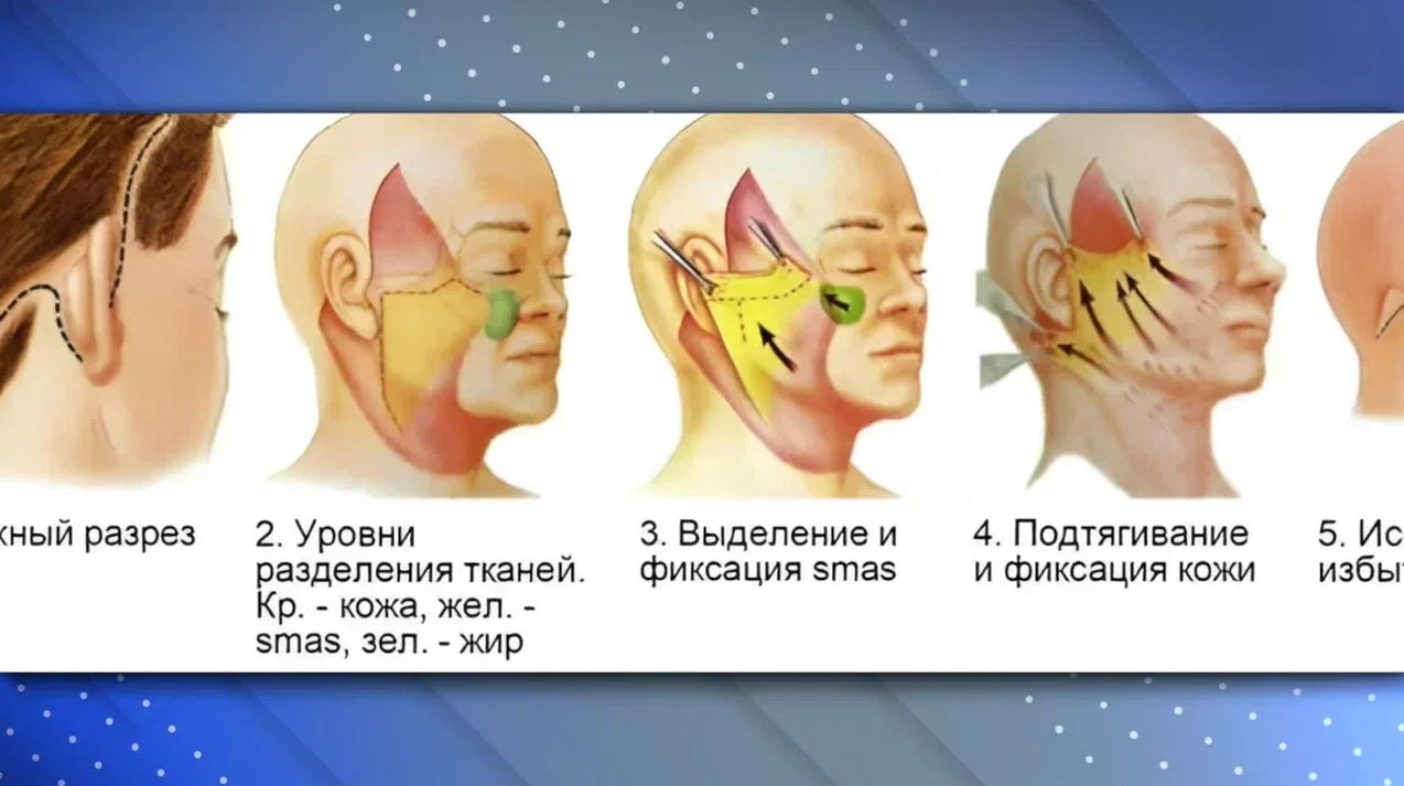 Максимилиан Свиридов - эндоскопический лифтинг и СМАС лифтинг
