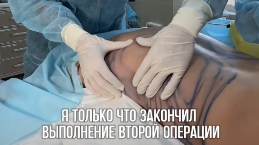Выполнил липосакцию талии, спины, лобковой зоны