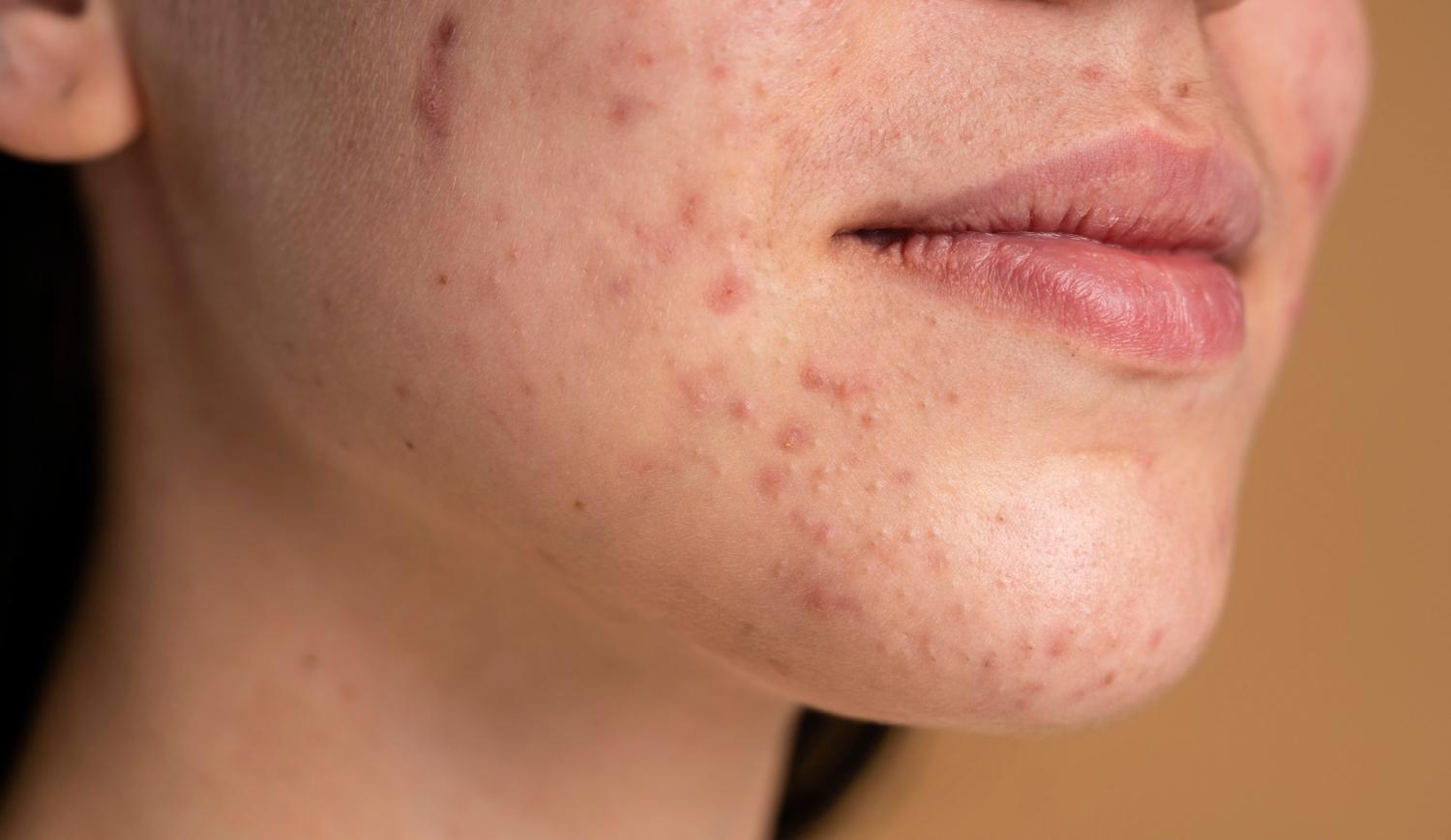 Фототерапия акне