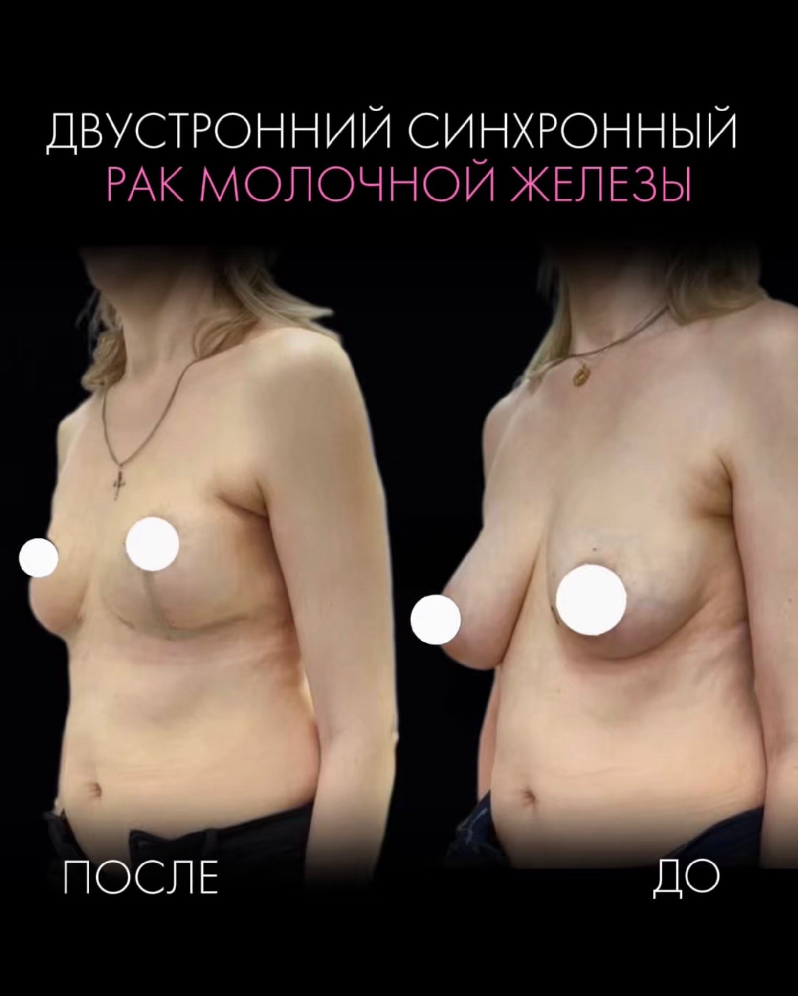 На фото - двусторонний синхронный рак молочных желёз