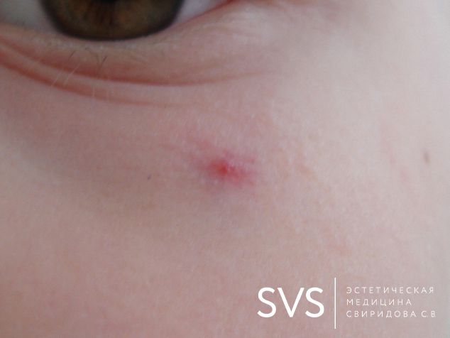 Удаление расширенных сосудов