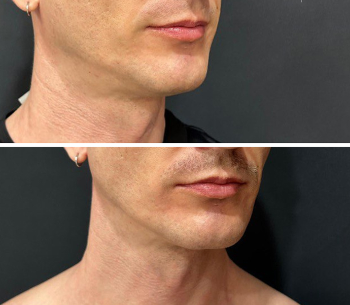 Эффективность процедур, от чего зависит?