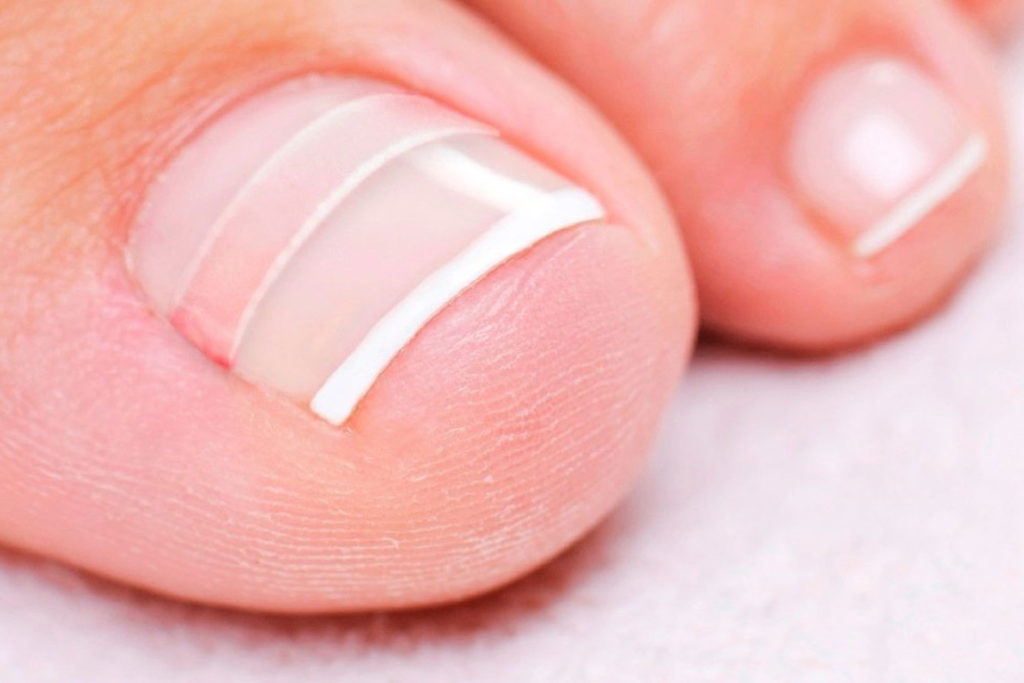 Лечение вросшего ногтя