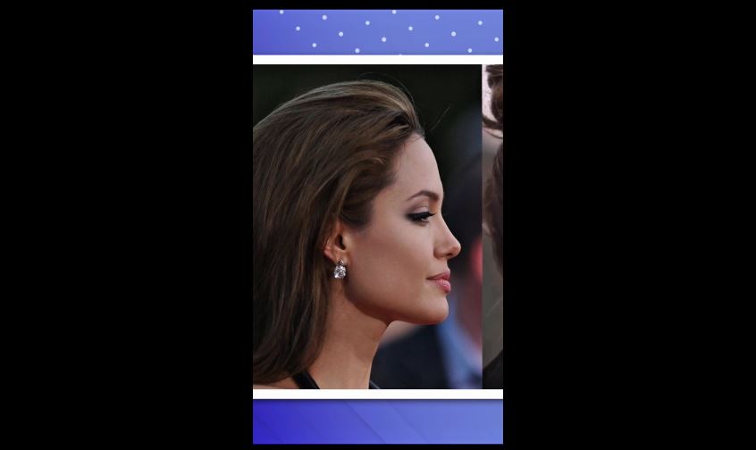 Возможно ли спасти лицо с последствиями неграмотной контурной пластики?