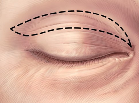 Пластика нижних век