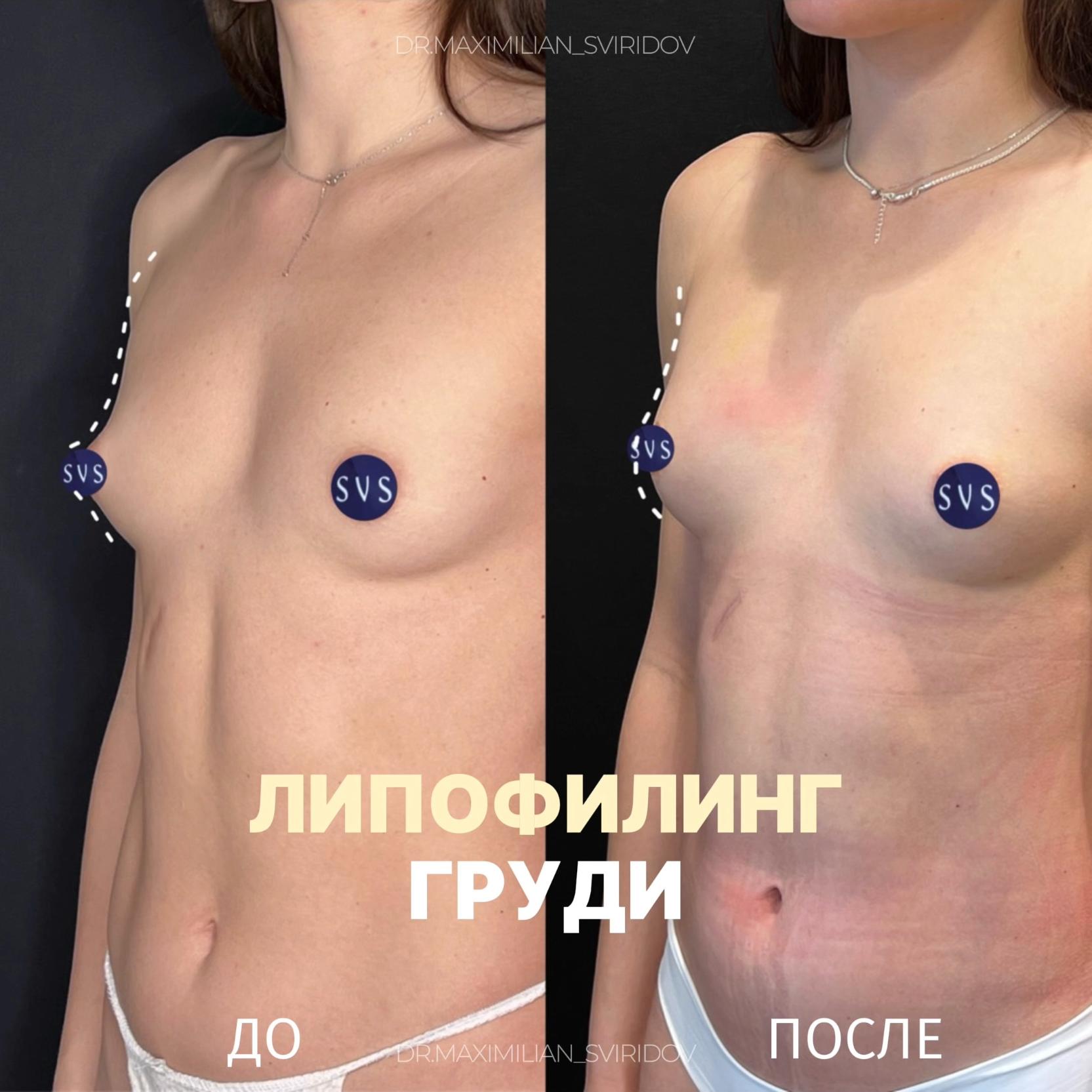 «Я не хочу большую грудь. И не хочу импланты».