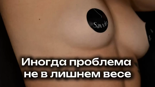 3 недели после липопластики тела. 