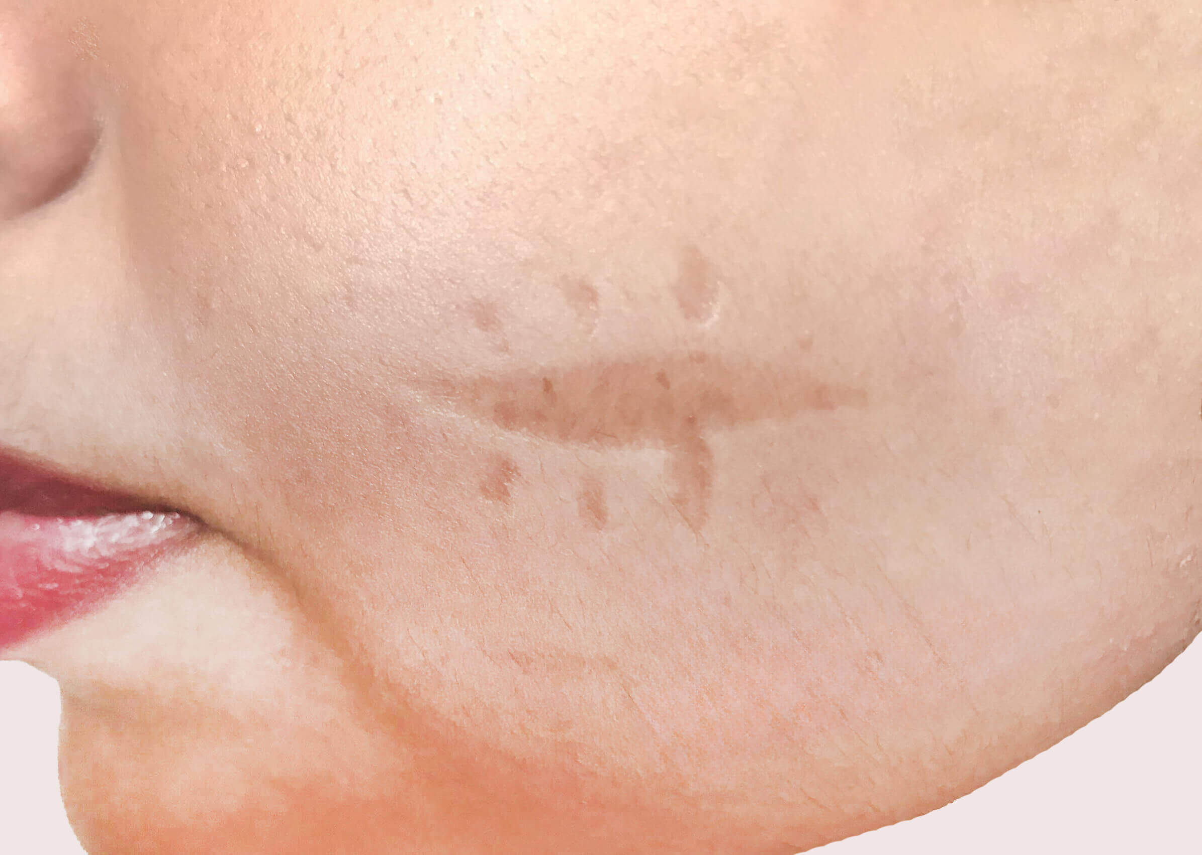 Лечение рубцов и шрамов