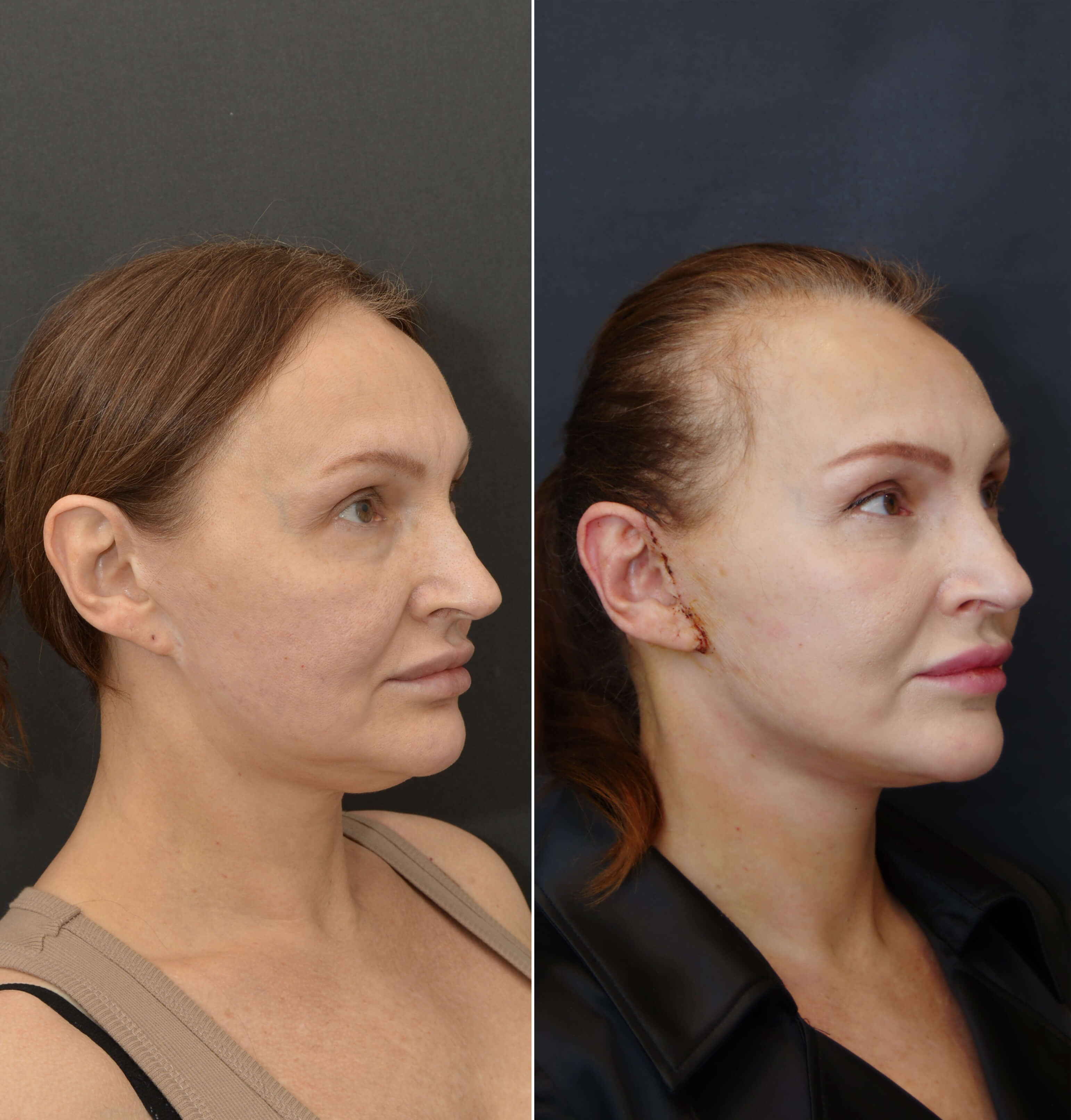 14 дней после SMAS лифтинга...