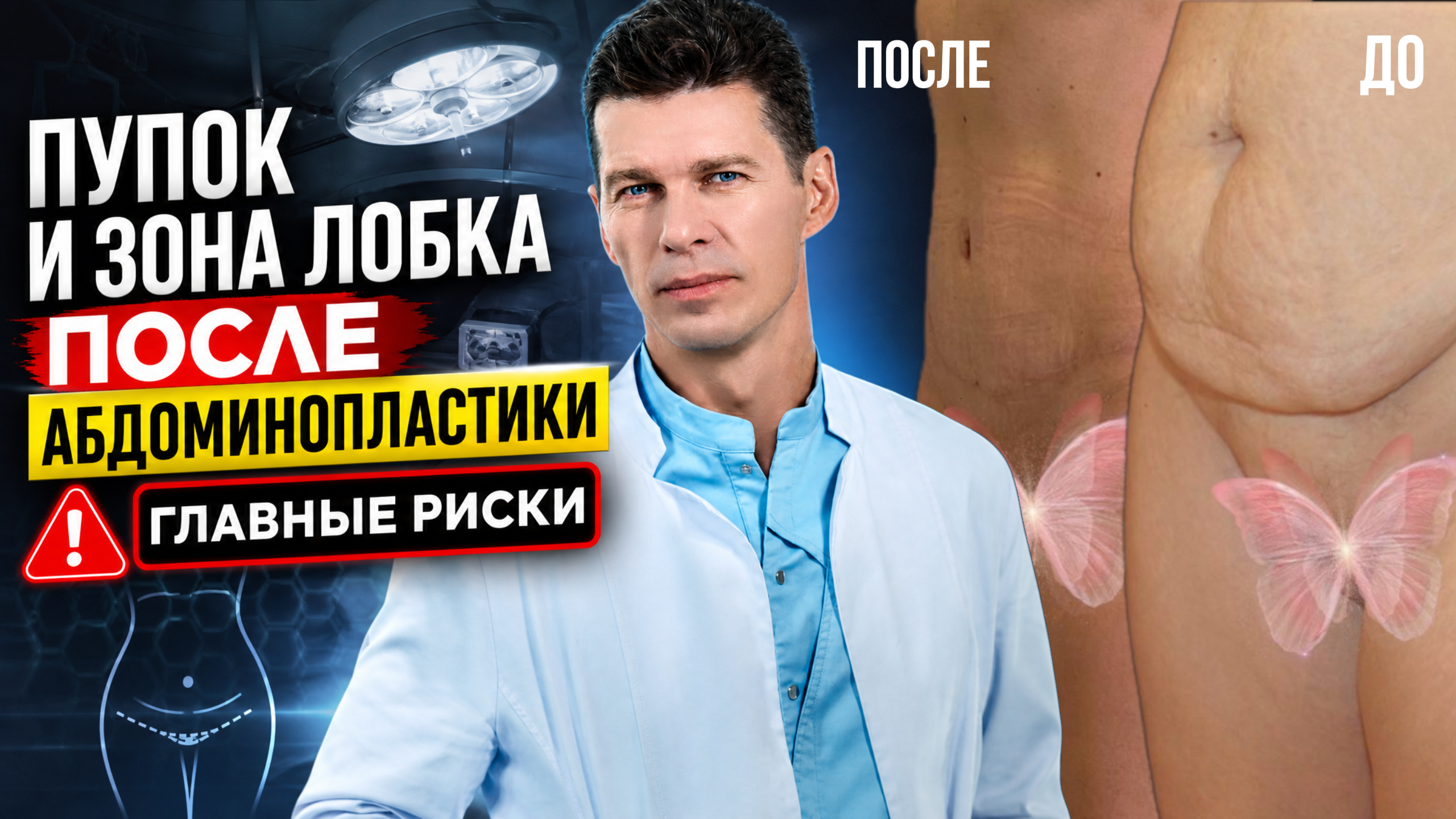 Пупок и зона лобка после абдоминопластики