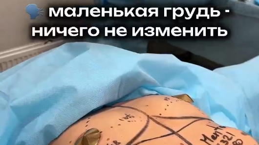 Выполнено бесшовное увеличение груди. 