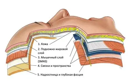 Ультразвуковой смас-лифтинг UltraFormer MPT