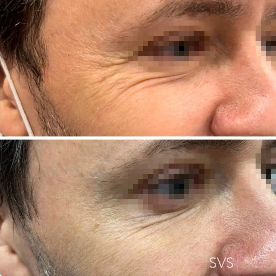 Результаты ботулинотерапии у мужчин!