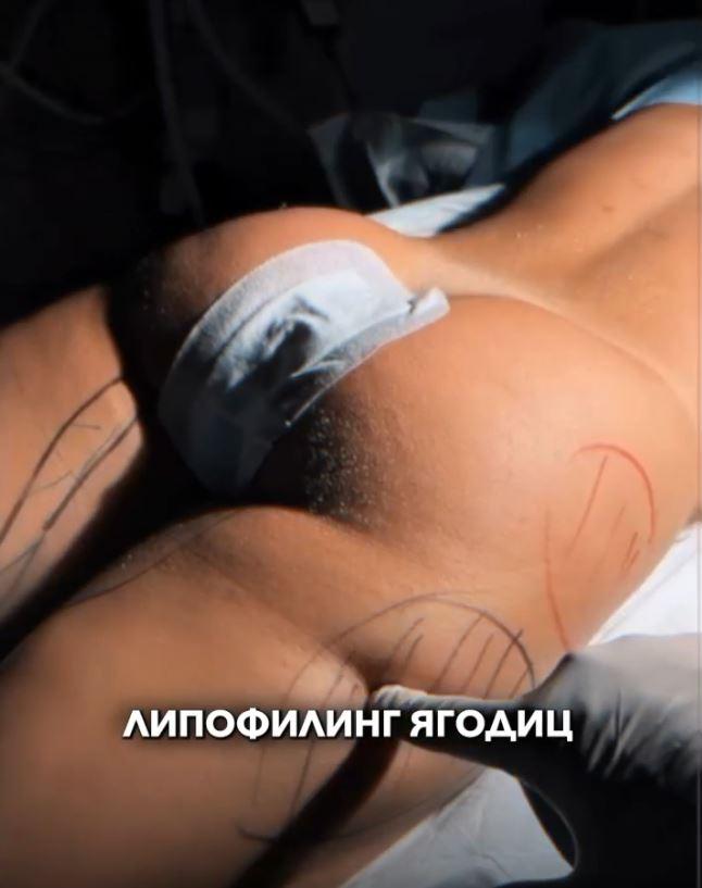 Импланты в ягодицы: риски и безопасная альтернатива — липофилингм