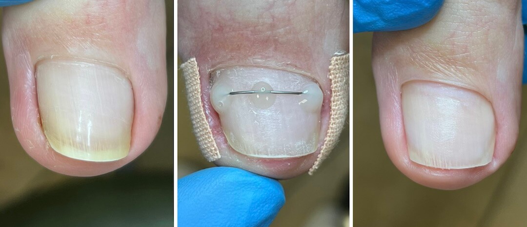 Лечение вросшего ногтя