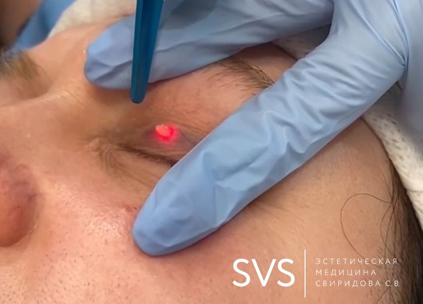 лазерная хирургия