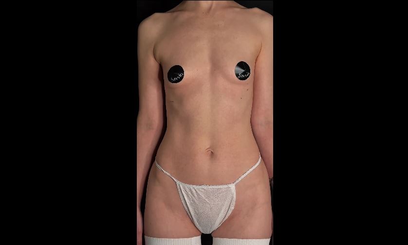 Увеличение груди: каким будет результат через 1 месяц?