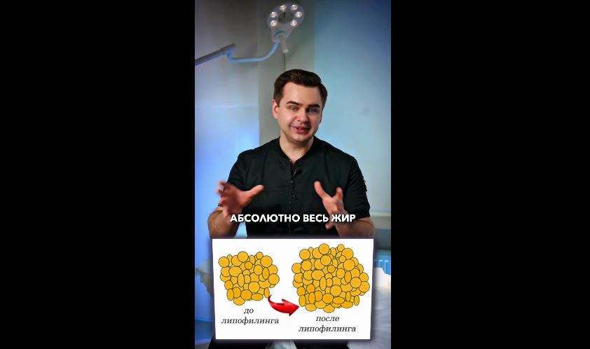 Липофилинг — это метод коррекции и омоложения с использованием собственного жира пациента.