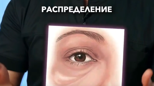 Блефаропластика