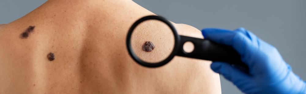 Удаление кондиломы