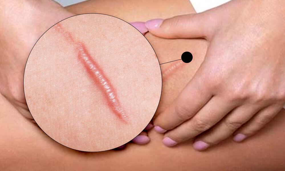 Лечение рубцов и шрамов