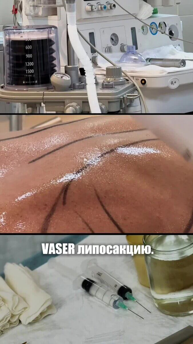 Один из самых частых запросов в пластической хирургии…