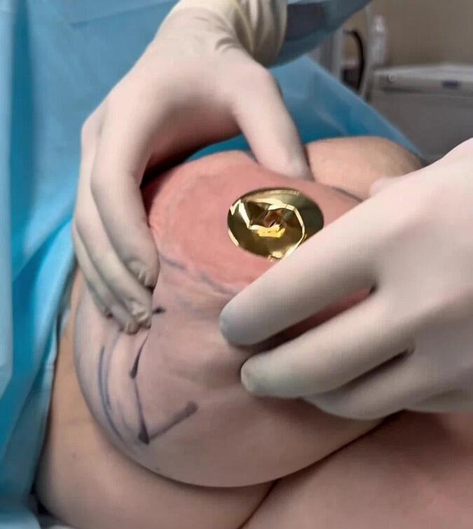 Пациентке выполнено уменьшение молочных желез. 