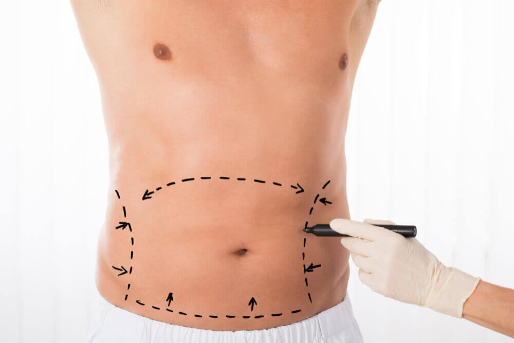 Липоскульптурирование