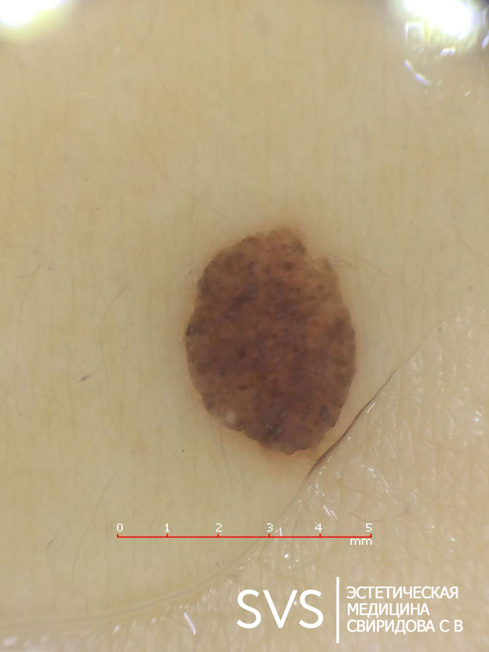 Удаление невуса (родинок)