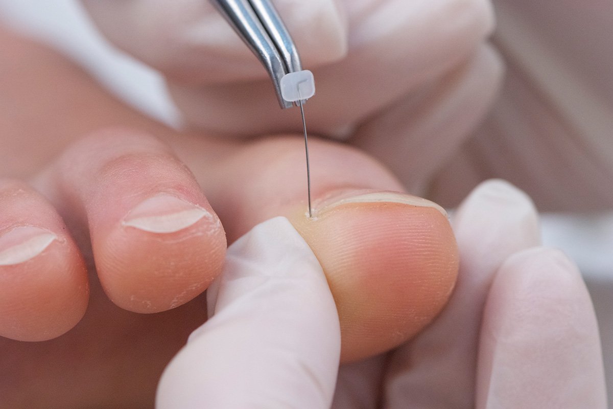 Лечение вросшего ногтя