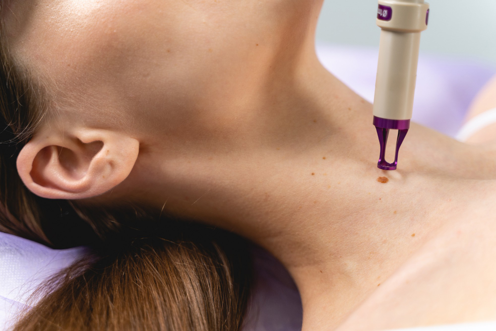 Удаление кондиломы